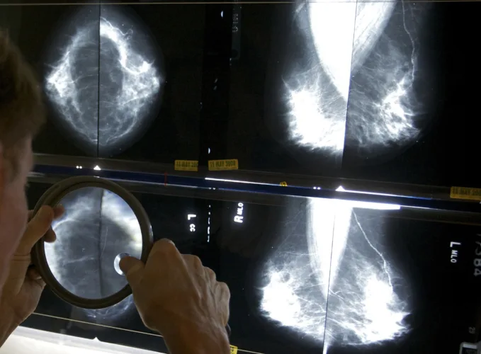 Early detection saves lives: Prioritize routine breast cancer screenings
